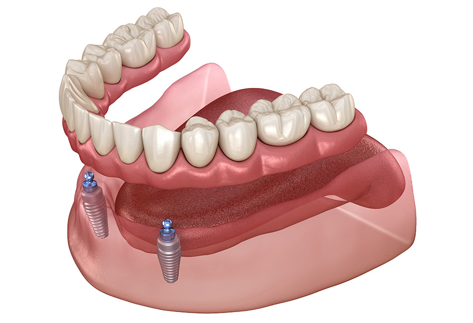 overdenture-tile