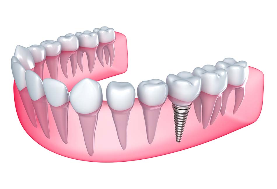 single-implant-tile